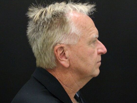 Face & Neck Lifts: Case 32 - Before