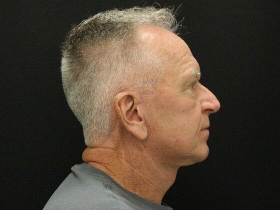 Face & Neck Lifts: Case 32 - After