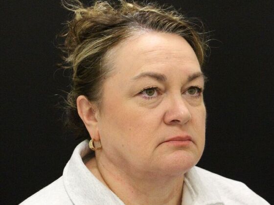 Face & Neck Lifts: Case 33 - After