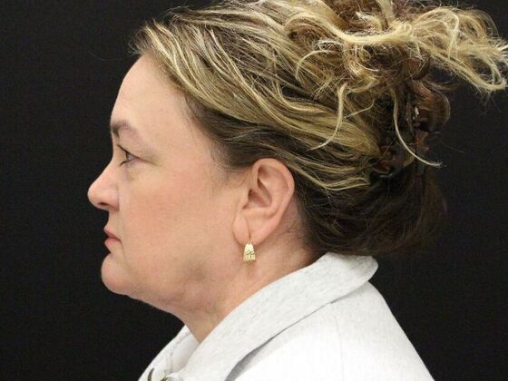 Face & Neck Lifts: Case 33 - After
