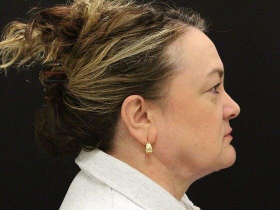 Face & Neck Lifts: Case 33 - After