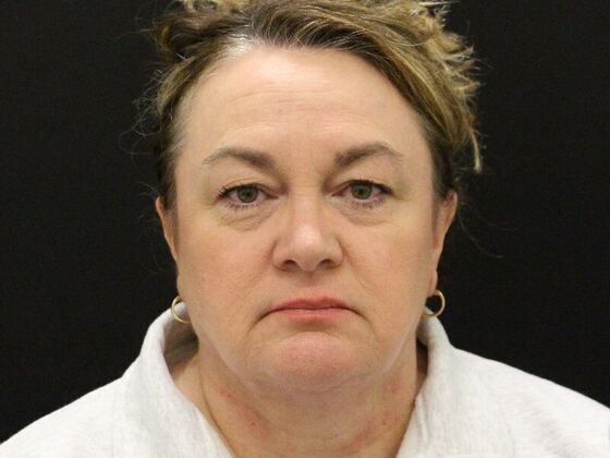 Face & Neck Lifts Case 33 - After