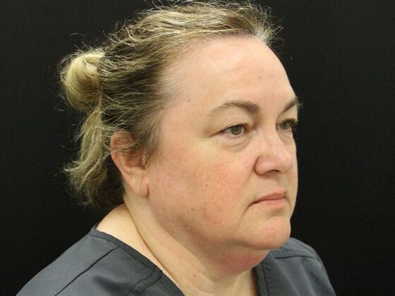 Face & Neck Lifts: Case 33 - Before