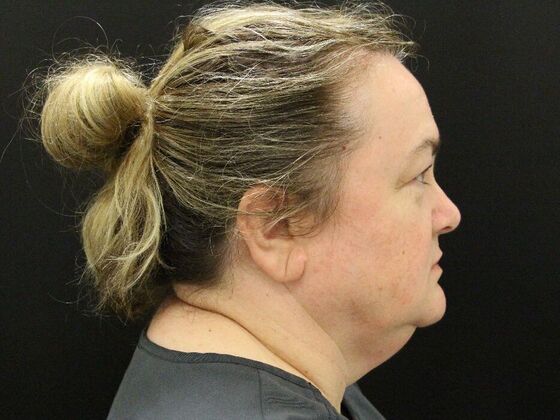 Face & Neck Lifts: Case 33 - Before