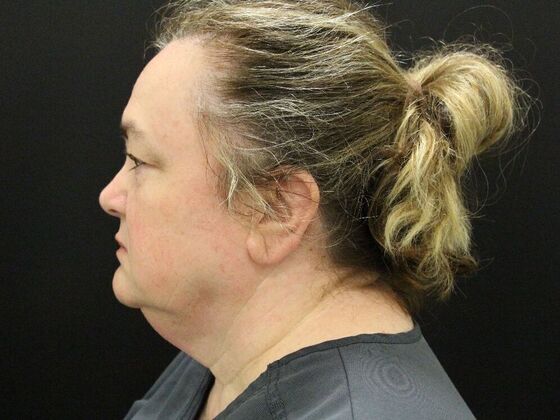 Face & Neck Lifts: Case 33 - Before