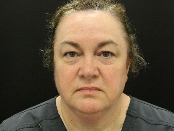 Face & Neck Lifts Case 33 - Before