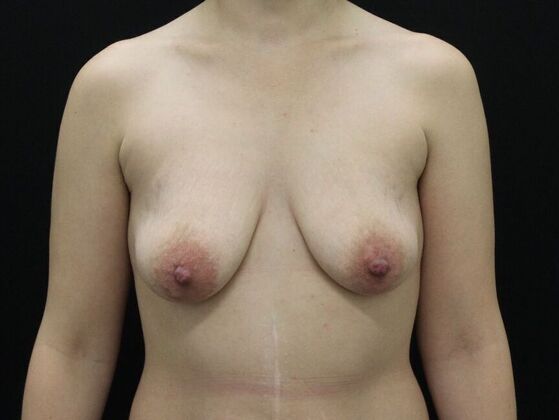 Breast Lift/Breast Lift Augmentation Case 48 - Before