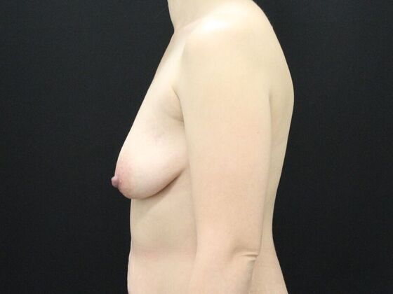 Breast Lift/Breast Lift Augmentation: Case 48 - Before
