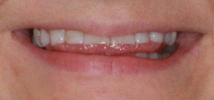 Porcelain Veneers and Crowns Case 8 - Before