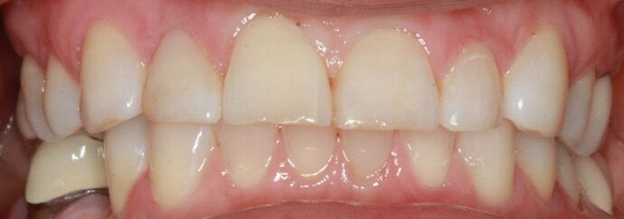 Porcelain Veneers and Crowns: Case 8 - Before