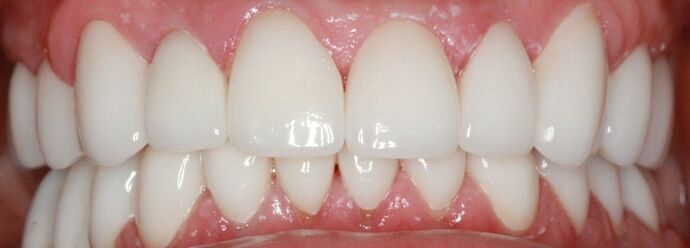 Porcelain Veneers and Crowns: Case 8 - After