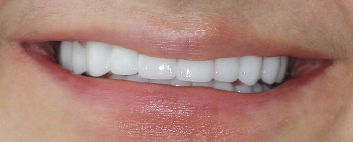 Porcelain Veneers and Crowns Case 8 - After