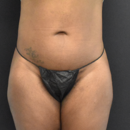 Abdominoplasty Case 12 - Before