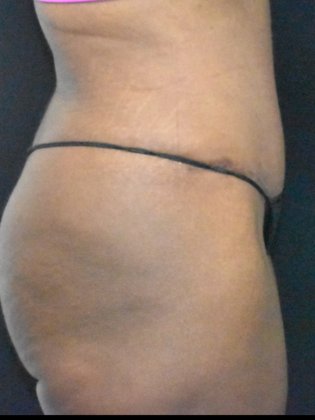 Abdominoplasty: Case 12 - After