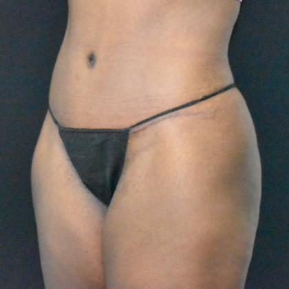 Abdominoplasty: Case 12 - After