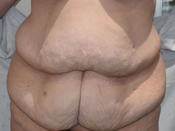 Tummy Tuck (Abdominoplasty): Case 458 - Before