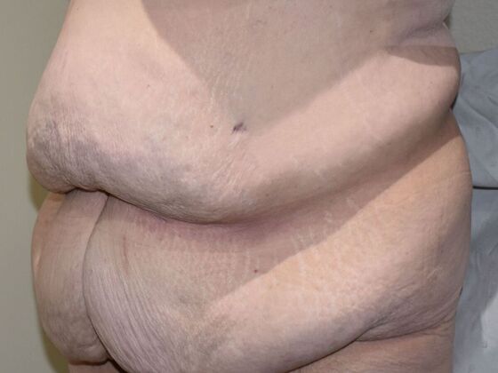 Tummy Tuck (Abdominoplasty): Case 458 - Before