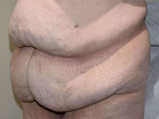 Massive Weight Loss : Case 143 - Before