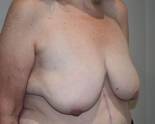 Breast Augmentation w/ Lift: Case 515 - Before