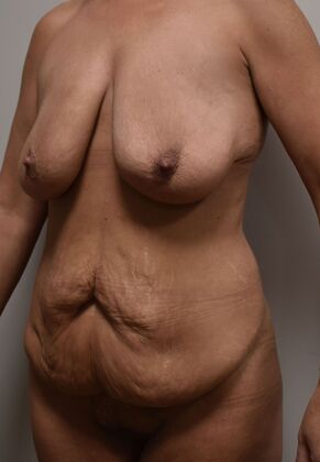 Mommy Makeover: Case 293 - Before