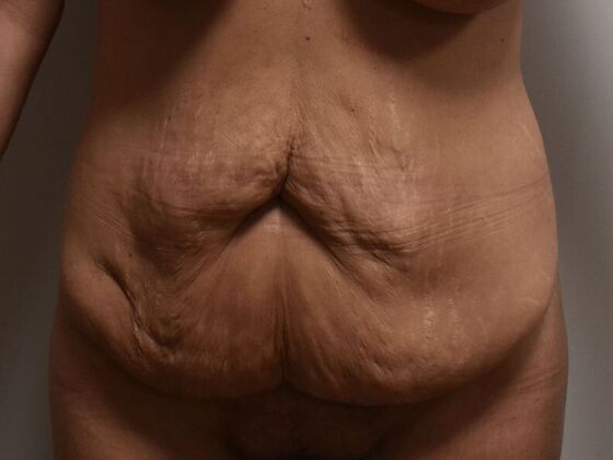 Tummy Tuck (Abdominoplasty): Case 459 - Before