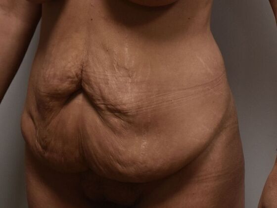 Tummy Tuck (Abdominoplasty): Case 459 - Before