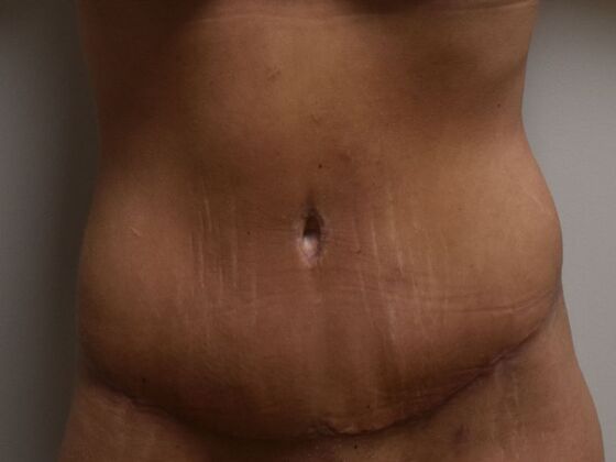 Tummy Tuck (Abdominoplasty): Case 459 - After
