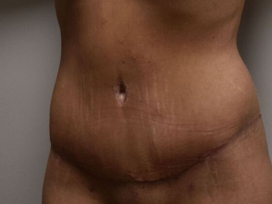 Tummy Tuck (Abdominoplasty): Case 459 - After