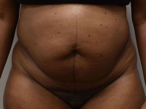 Tummy Tuck (Abdominoplasty): Case 460 - Before
