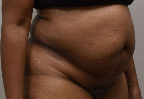 Tummy Tuck (Abdominoplasty): Case 460 - Before