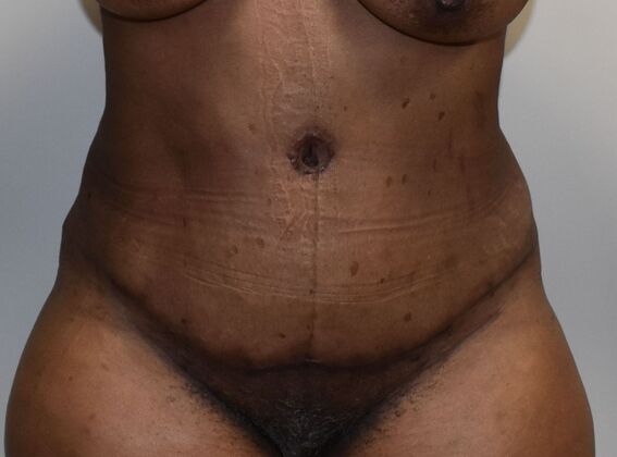 Tummy Tuck (Abdominoplasty): Case 460 - After