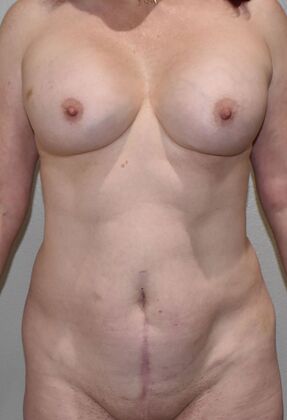 Mommy Makeover Case 294 - Before