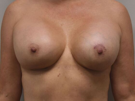 Breast Revision: Case 235 - After