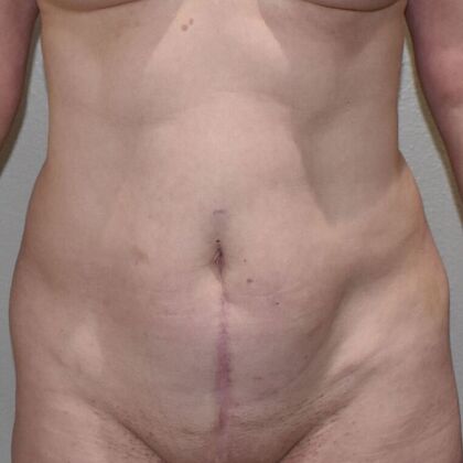 Tummy Tuck (Abdominoplasty): Case 461 - Before