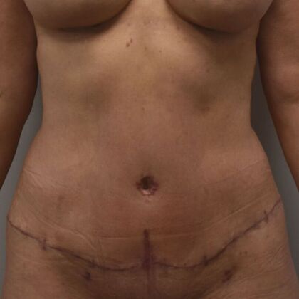 Tummy Tuck (Abdominoplasty): Case 461 - After