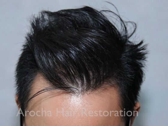 FUT Hair Restoration Case 37 - After