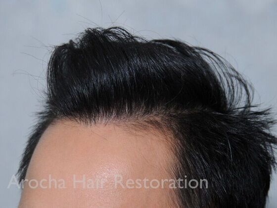 FUT Hair Restoration: Case 37 - After