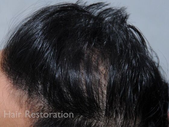 FUT Hair Restoration: Case 37 - After