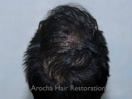 FUT Hair Restoration: Case 37 - After