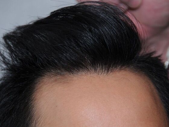 FUT Hair Restoration: Case 37 - After