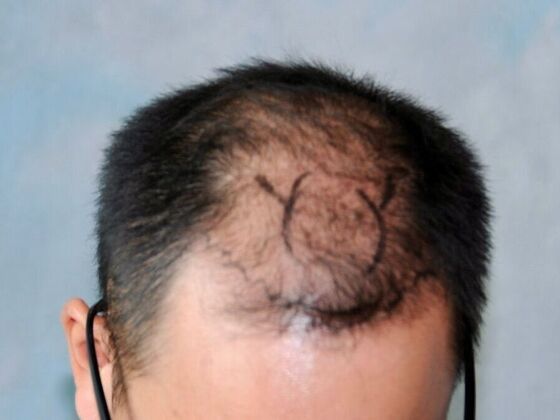 FUT Hair Restoration: Case 37 - Before