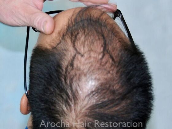 FUT Hair Restoration: Case 37 - Before