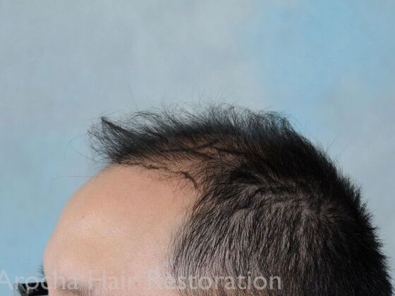 FUT Hair Restoration: Case 37 - Before