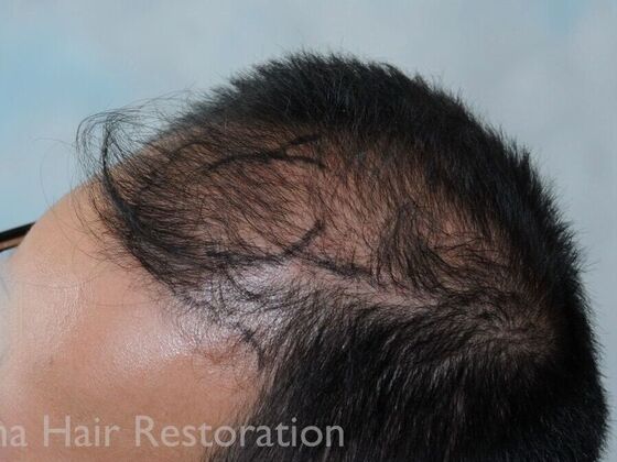 FUT Hair Restoration: Case 37 - Before