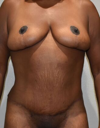 Mommy Makeover Case 295 - After