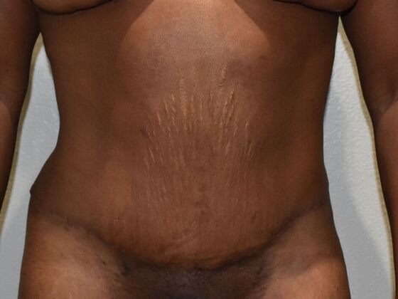 Tummy Tuck (Abdominoplasty): Case 462 - After