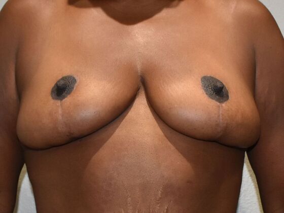 Breast Lift (Mastopexy) Case 192 - After