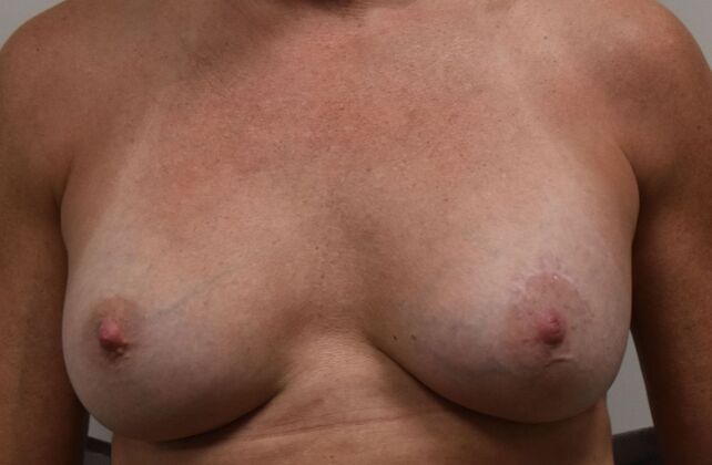 Breast Augmentation Case 752 - After