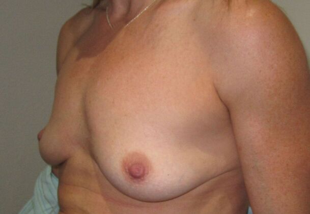 Breast Augmentation w/ Lift: Case 517 - Before