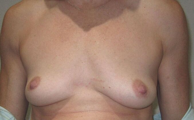 Breast Augmentation w/ Lift: Case 517 - Before